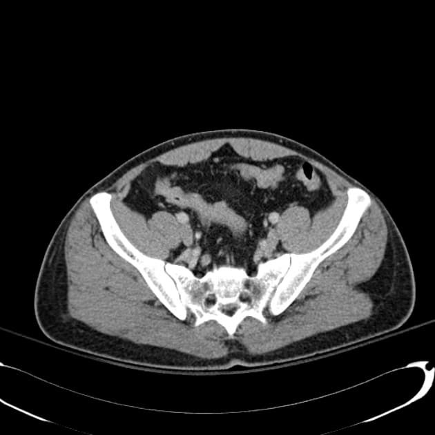снимок КТ органов малого таза
